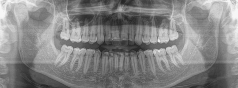 Панорамный снимок-ортопантомография (ОПТГ)