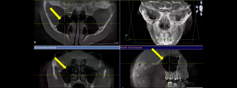 КТ придаточных пазух