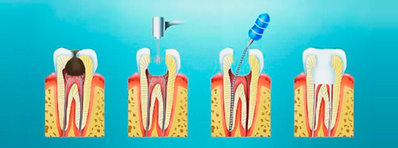 этапы лечение пульпита