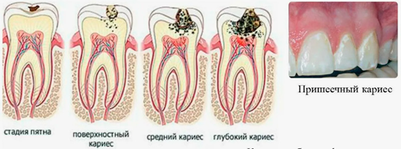 лечение кариеса