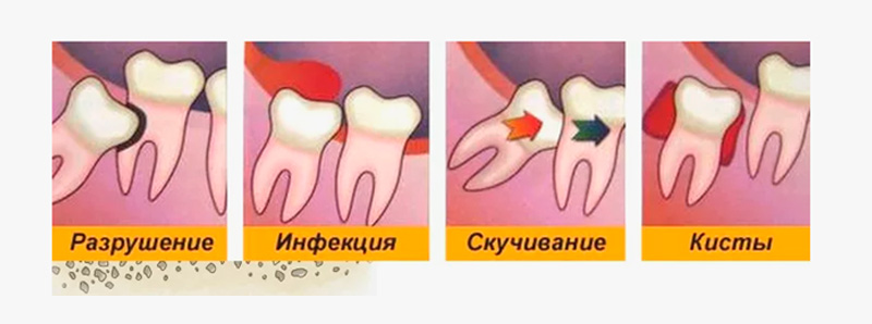 прорезывание восьмерки