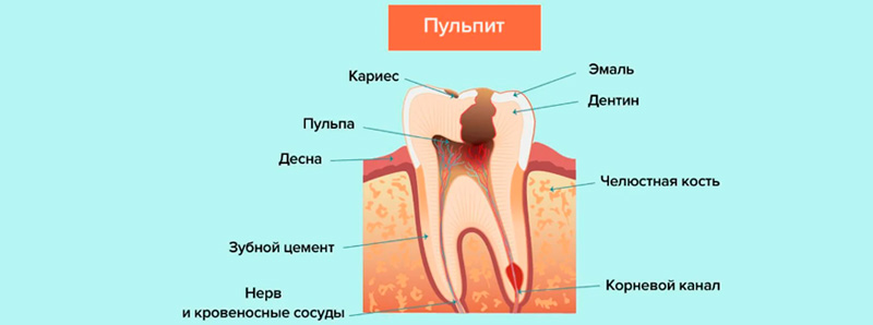 лечение Пульпита