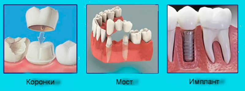 Мостовоидные протезы 