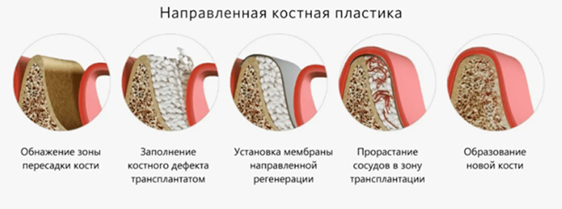 Направленная регенерация