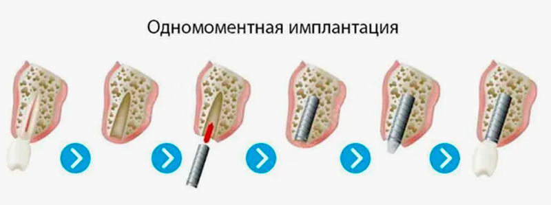 Виды одномоментной имплантации зуба