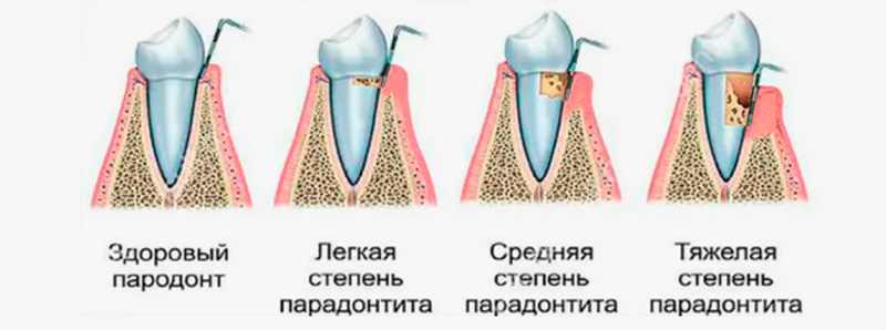 виды пародонтита