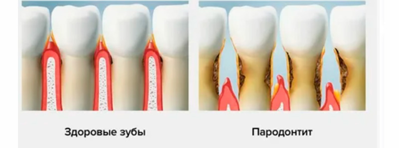 лечение пародонтита