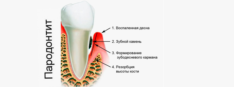 что такое пародонтит