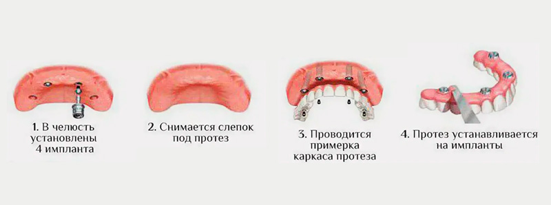 Как происходит имплантация All-on-4